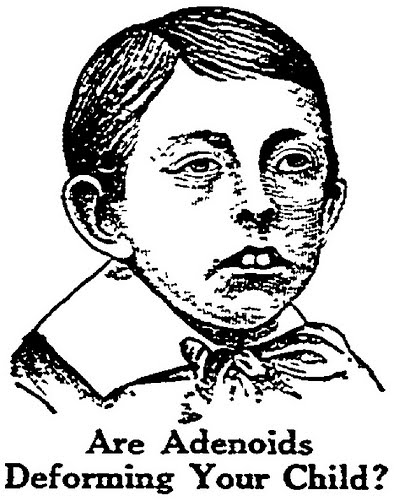 Picture Of Adenoids